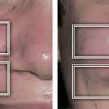 апаратний масаж обличчя icoone laser med