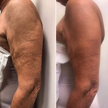 апаратний масаж тіла icoone laser med