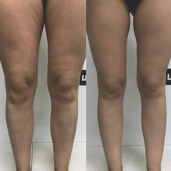 апаратний масаж тіла icoone laser med