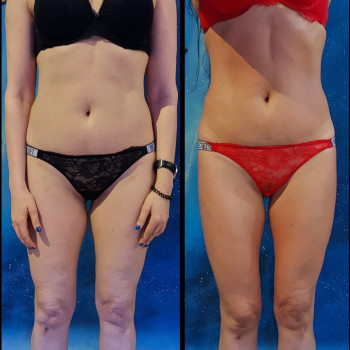 Результат комплексної роботи: •16 сеансів масажу   +8обго