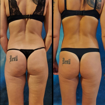 Результат комплексної роботи: -13 сеансів масажу + обгортан