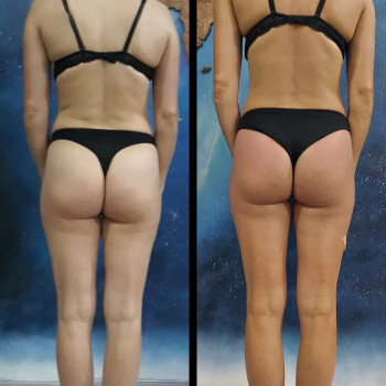 Результат комплексної роботи: •10 сеансів масажу   
•інд