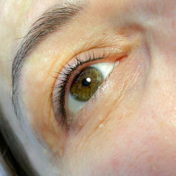 Загоєний перманент міжвійки перед корекцією