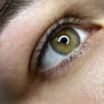 Загоєний перманент міжвійки перед корекцією