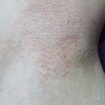 Електроепіляція
                    Майстер депіляції Ірина Рівне