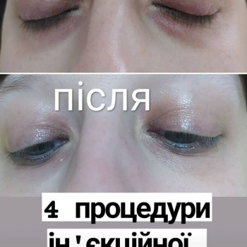 в області навколо очей темні кола, мішки та грижі зменшуються завдяки покращенню лімфотоку та начисе...