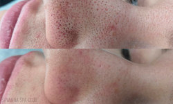 Чистка лица Масажний салон Body Line Ірпінь