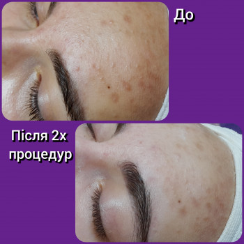 Атравматична чистка