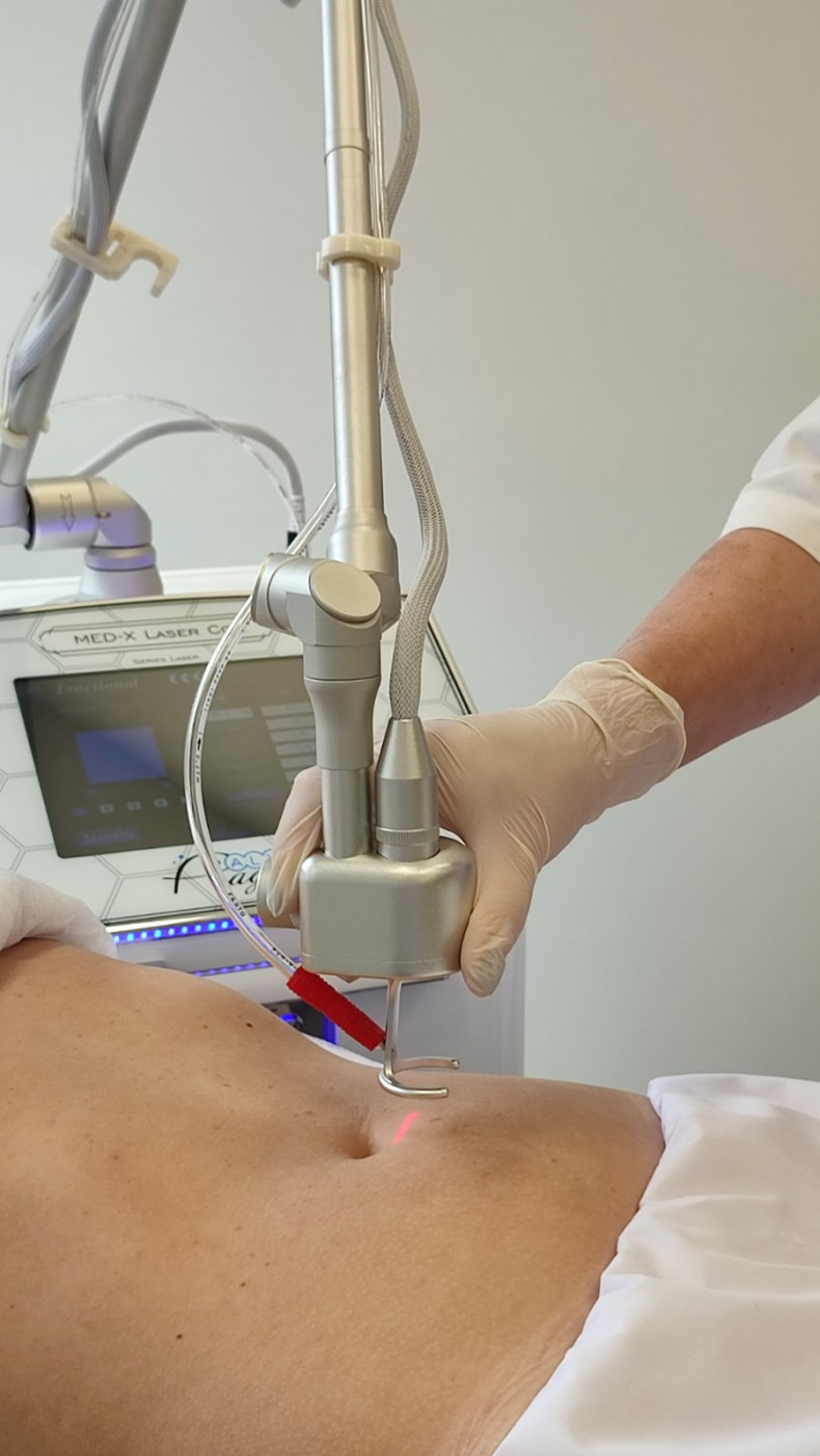 Лазерне шліфування на апараті MED-X Laser СО2, фото - Медицинский центр Bilyk - Ultra Laser