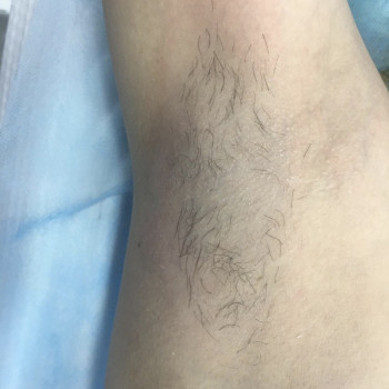 Электроэпиляция
                    Мастер депиляции Юлия Одесса