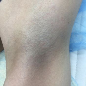 Электроэпиляция
                    Мастер депиляции Юлия Одесса