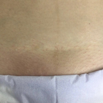 Электроэпиляция
                    Мастер депиляции Юлия Одесса