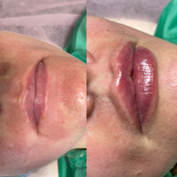 Аугментація губ філлером Stylage
                    Косметолог-инъекционист Наталия Киев