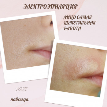 Електроепіляція обличчя - 12 грн / 1хв
                    Косметолог Юлія Киев