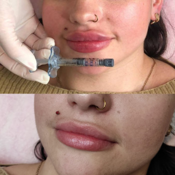 Контурна пластика губ
                    Косметолог Людмила Киев