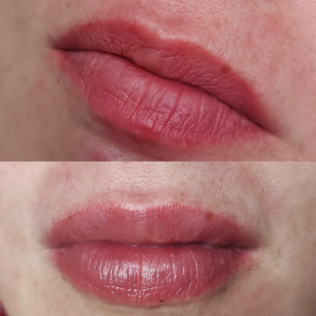 Контурна пластика губ
                    Косметолог Людмила Киев