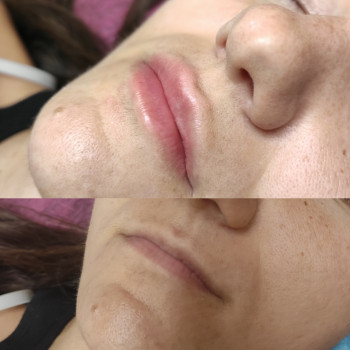 Контурна пластика губ
                    Косметолог Людмила Киев