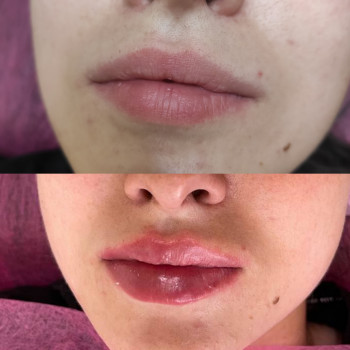 Контурна пластика губ
                    Косметолог Людмила Киев