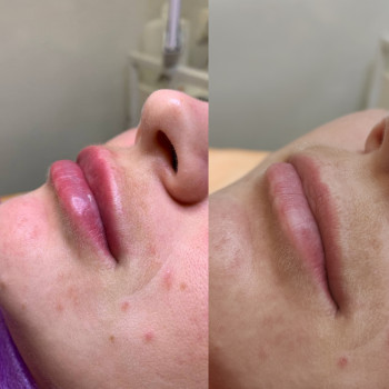 Контурна пластика губ
                    Косметолог Людмила Киев