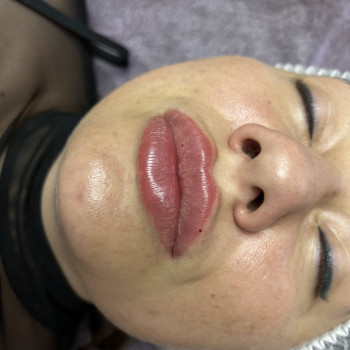 Аугмінтація губ