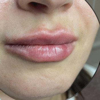 Аугмінтація губ