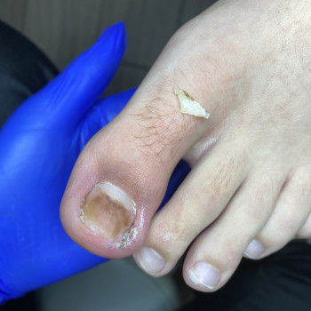 Подологічний педикюр
                    Салон красоты Міа Бʼюті Винница