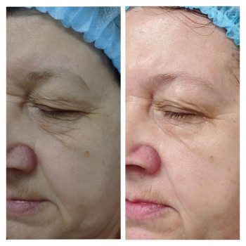 Клієнта 62 роки до та після 3 процедур