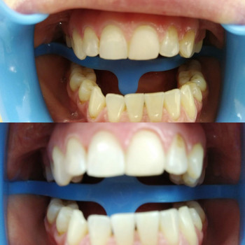 Відбілювання зубів