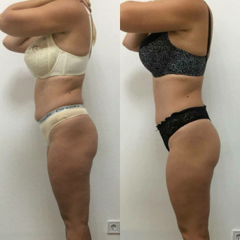 Эндосфера терапия / EndoSpheres Therapy / Ендосфера терапія