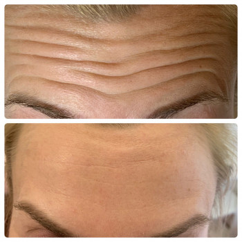 Ботокс в лоб
                    Косметологический центр WE Cosmetology Киев