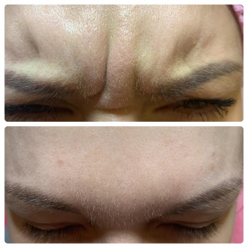 Ботокс в міжбрів'я
                    Косметологічний центр WE Cosmetology Київ