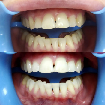 отбеливание зубов