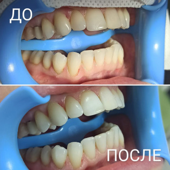 отбеливание зубов