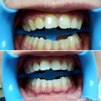 Лазерное отбеливание зубов
                    Стоматологічна клініка Формула 1 Черкаси