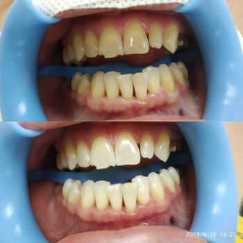 Лазерное отбеливание зубов
                    Стоматологічна клініка Формула 1 Черкаси