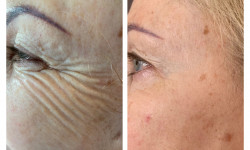 Ботокс губ Косметологический центр WE Cosmetology Киев