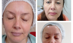 Термоліфтинг Косметологічний центр WE Cosmetology Київ
