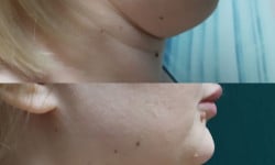 Кріоліполіз аплікатор підборіддя Косметологічний центр Ендосфера центр Кременчук