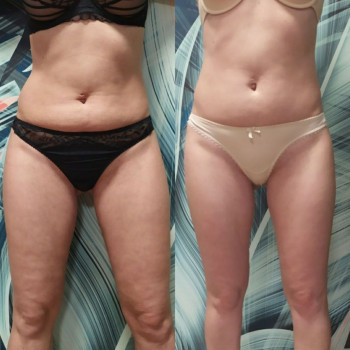 Эндосфера терапия / EndoSpheres Therapy / Ендосфера терапія