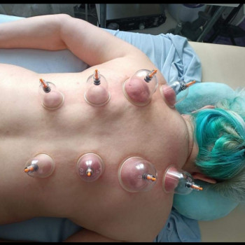 Баночный массаж