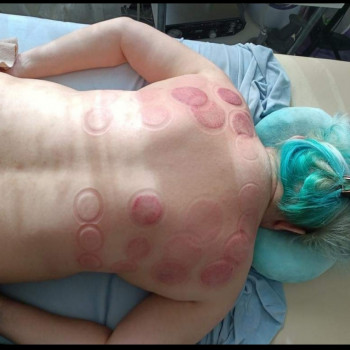 Баночный массаж