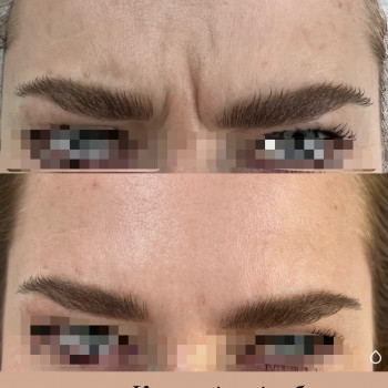 Ботулинотерапия
                    Косметолог-ін'єкціоніст Алина Дніпро