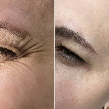 Ботулинотерапия
                    Косметолог-ін'єкціоніст Алина Дніпро