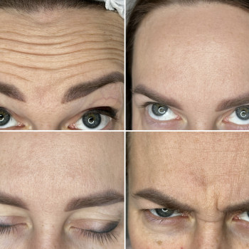 Ботулинотерапия
                    Косметолог-ін'єкціоніст Алина Дніпро