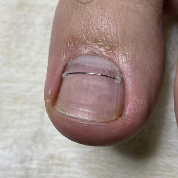 Корекційна система при врослому нігті - титанова нитка
                    Подолог Наталія Киев