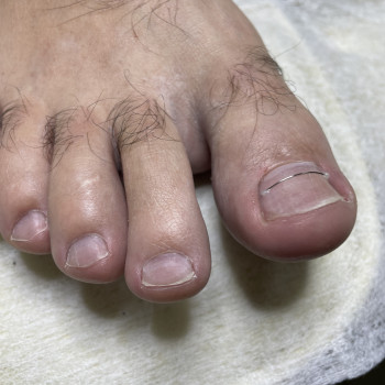 Корекційна система при врослому нігті - титанова нитка
                    Подолог Наталія Киев