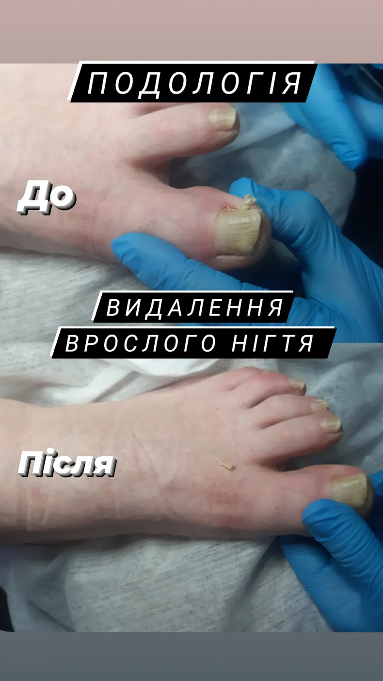 Удаление более длинного ногтя, фото - Салон краси Салон краси Meri & Meri