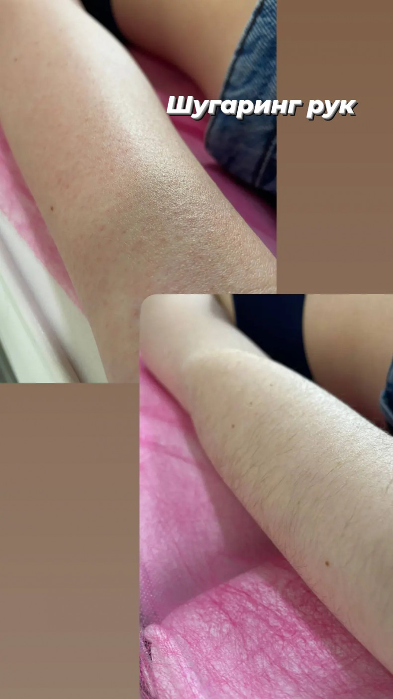 Шугаринг рук, фото - Салон красоты Салон краси Meri & Meri