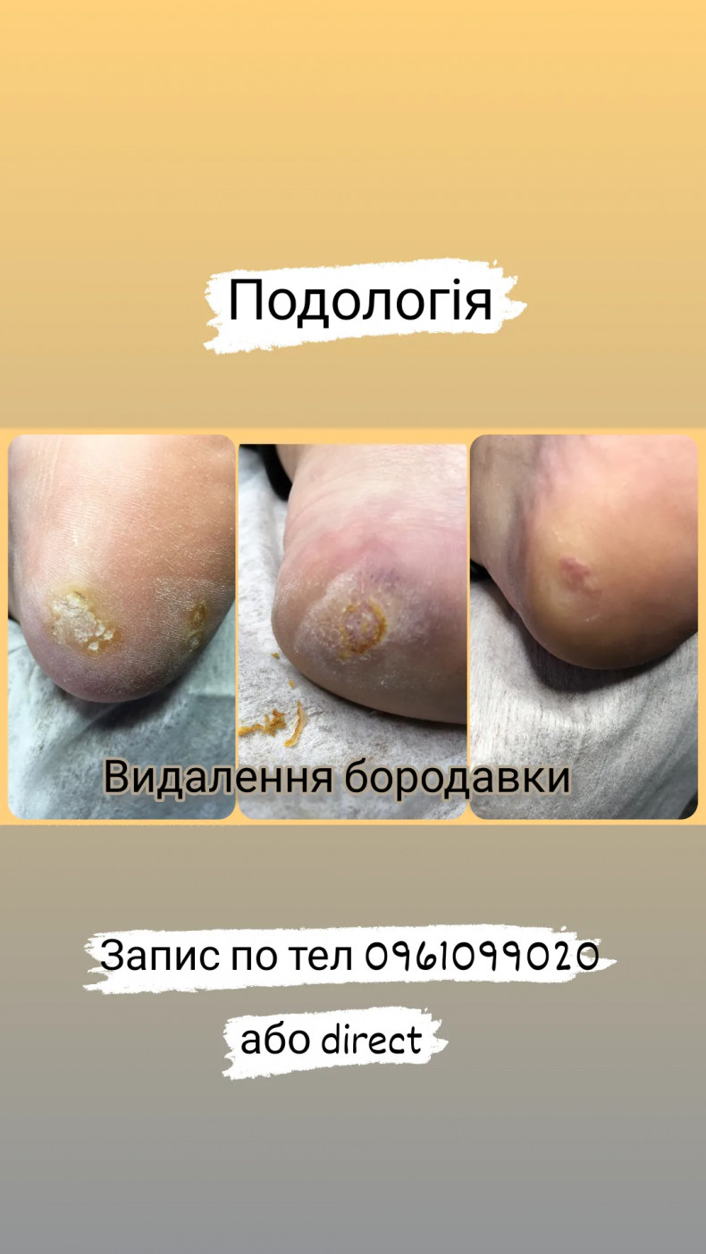Видалення бородавок, фото -  