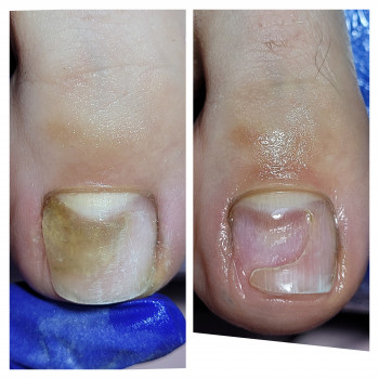 Обробка оніхолізу (як наслідок і причину)